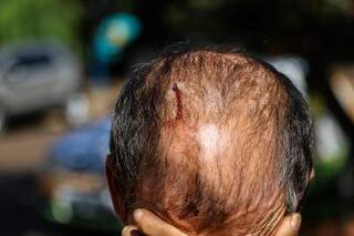 Morador de rua mostra corte feito em sua cabeça após ser atingido por cassetete. (Foto: André Bittar) 