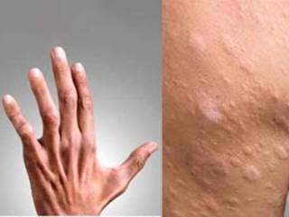Imagens de pele com sintomas de Hanseníase. (Foto: Reprodução)