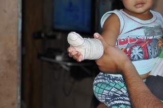 Menino ainda está com a mão enfaixada por conta da cirurgia (Foto: Marcelo Calazans)