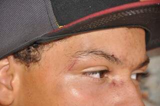 Garoto teve dois dedos quebrados e ferimentos no rosto. (Foto: Marcelo Calazans)