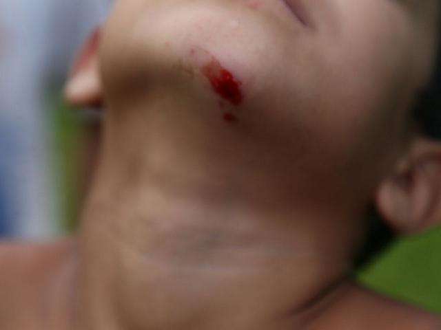Garoto fica ferido ao ser atingido por roj&atilde;o jogado por adolescentes