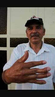 Após um acidente de trabalho, Sérgio ficou um deficiência nos três dedos da mão direita. (Foto: Reprodução/ Facebook