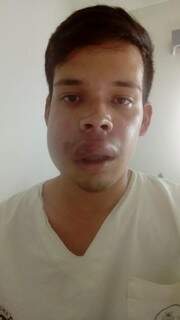 Hernán Daniel Alves Teixeira, 21 anos, foi picado por uma aranha e foi internado após complicações (Divulgação)