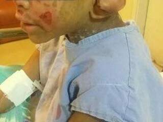 Criança teve vários ferimentos, principalmente de queimaduras no rosto e pescoço.  (Foto: divulgação) 