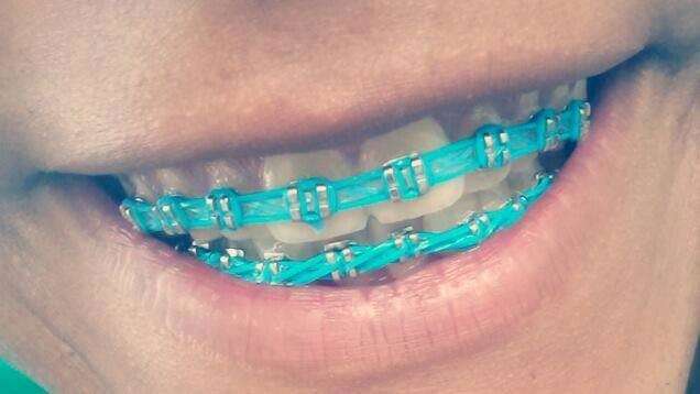 CRO-MS faz a&ccedil;&atilde;o para coibir &quot;modinha&quot; de colocar el&aacute;sticos em aparelho dent&aacute;rio