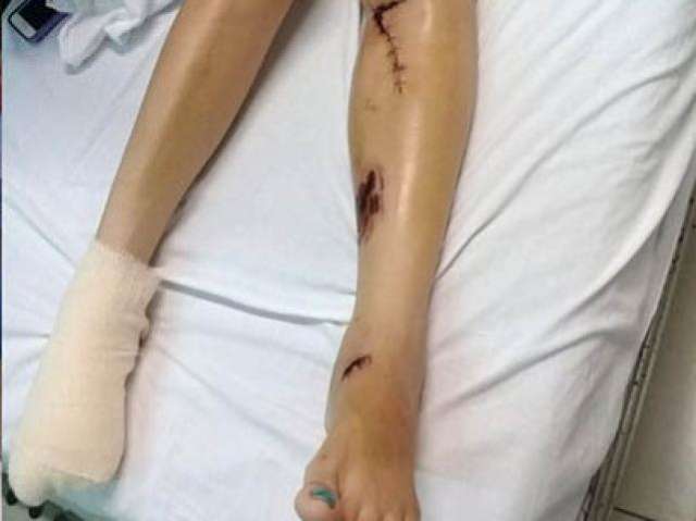 Ciclista atropelada por &ocirc;nibus deixa UTI e deve receber pr&oacute;tese 