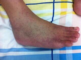 Sintomas da Chikungunya nos pés de um paciente. (Foto: Reprodução)