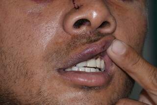 Daniel teve fratura no nariz, além de arranhões e hematomas pelo corpo (Foto: Vanderlei Aparecido)