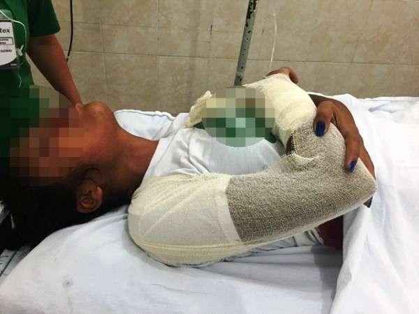 Mulher sofre fratura exposta ao ficar com bra&ccedil;o preso em cilindro de m&aacute;quina