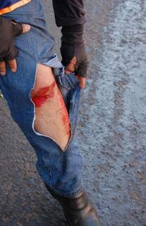 Mototaxista mostra perna ferida em acidente.