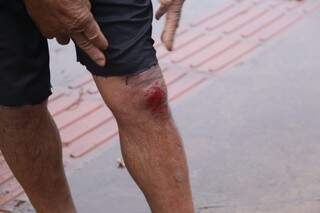 Ferimento causado na perna do trabalhador. (Foto: Kisie Ainoã) 