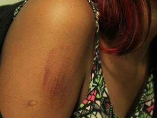 Adolescente mostra ferimento no braço causada por uma pedra  (Foto: Marina Pacheco)