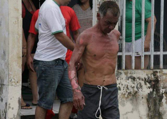  Homem sofre queimaduras ao tentar eliminar teias de aranha com fogo em Coxim