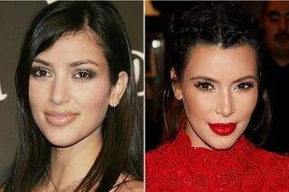 Antes e depois. Kim Kardashian removeu a laser os cabelos que nascem rente à raiz e e fez o preenchimento na testa. (Foto: Getty Images)
