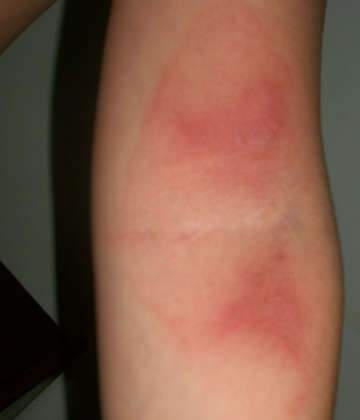  Menino de seis anos pode ter sido queimado com ferro de passar roupas em Coxim 