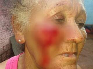 Idosa de 72 anos teve corte no rosto ao ser agredida pela filha (Foto: Direto das Ruas)