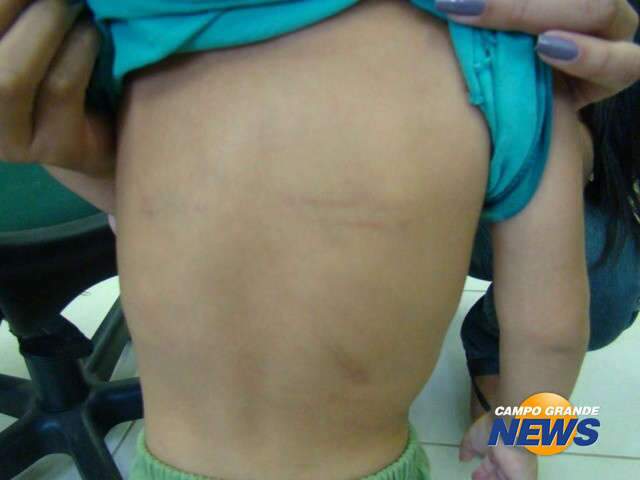  Les&otilde;es em beb&ecirc; foram provocadas por crian&ccedil;a de dois anos, diz Pol&iacute;cia 
