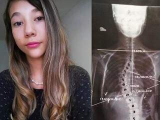 Adolescente de 13 anos já passou por um cirurgia que não resolveu o problema. (Foto: Divulgação) 