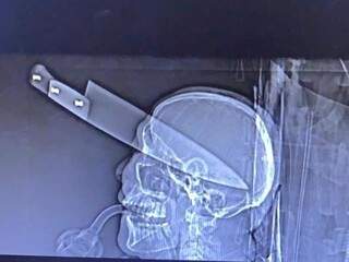 Imagem de raio-x com a faca ainda na cabeça da vítima.