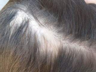 Madrasta &eacute; acusada de arrancar tufos de cabelo de enteada de 7 anos