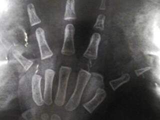 Exame de raios-X mostra que criança não chegou ao hospital com dedo amputado (Foto: arquivo pessoal)
