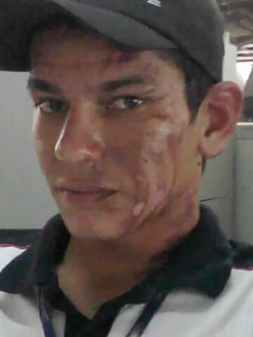  Jovem queimado depois de usar repelente espera indeniza&ccedil;&atilde;o pelas les&otilde;es e danos morais