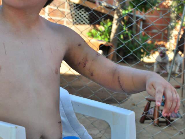  Menino mordido por pit bull afirma que c&atilde;o s&oacute; queria brincar 