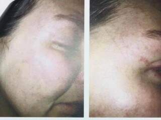 Fotos que mostram lesão no rosto de advogada foram anexadas ao pedido da OAB/ MS (Foto: Direto das Ruas)