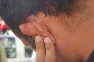 Segurança agredido com garrafada mostra lesão atrás da orelha. (Foto: Simão Nogueira)