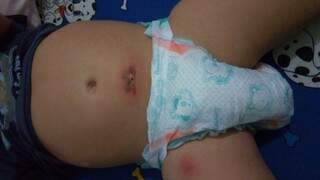 Mãe afirma que criança apresentou ferimentos depois de chegar do Ceinf (Direto das Ruas)