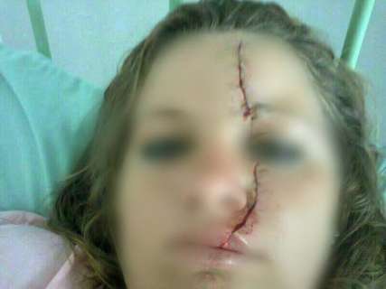 Adolescente tem rosto cortado por colega de escola durante briga