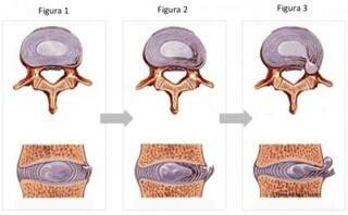 Gráfico mostra degeneração quando parte do disco  se desloca para trás ou então para um dos lados da coluna, o que acaba comprimindo o núcleo e provocando a hérnia.