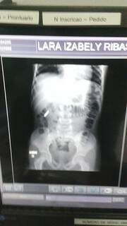 Exame de raio-x confirmou que a menina tinha engolido o objeto. (Foto: Arquivo Pessoal)