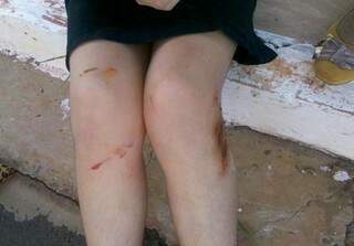 Menina machucou as pernas e ralou joelhos e cotovelos. (Foto: divulgação) 