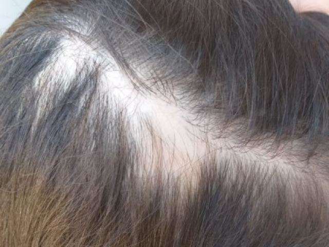 Madrasta &eacute; acusada de arrancar tufos de cabelo de enteada de 7 anos