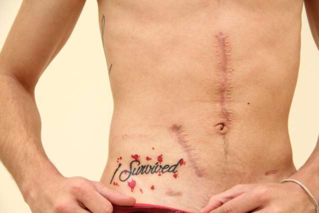 Depois de sentir piores dores por 4 dias, cicatriz virou tatuagem &quot;eu sobrevivi&quot;
