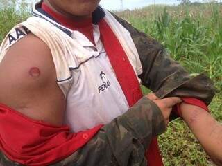 Índio mostra ferimentos supostamente provocados por bala de borracha (Foto: Direto das Ruas)
