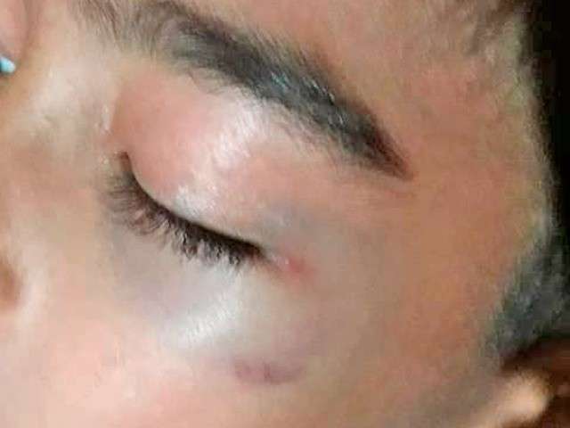 Menino de 9 anos chega em casa com olho roxo e m&atilde;e cobra escola