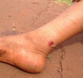 Esse índio mostra ferimento no tornozelo (Foto: Direto das Ruas)