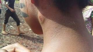Adolescente indígena com ferimento de bala de borracha durante ataque no dia 6 deste mês (Foto: Direto das Ruas)