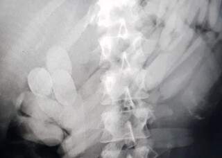 Após o exame de Raio-X foram encontradas várias cápsulas no intestino da boliviana (Foto: divulgação/PRF) 