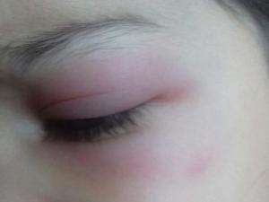 Crian&ccedil;a se machucada em creche e m&atilde;e denuncia omiss&atilde;o &agrave; secretaria 