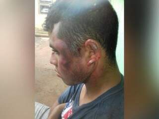 Rosto de Douglas Carneiro Cardoso após as agressões (Foto: Bruna Pasche)