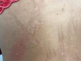 Marcas dos açoites nas costas da mulher (Foto: Polícia Civil/Divulgação)