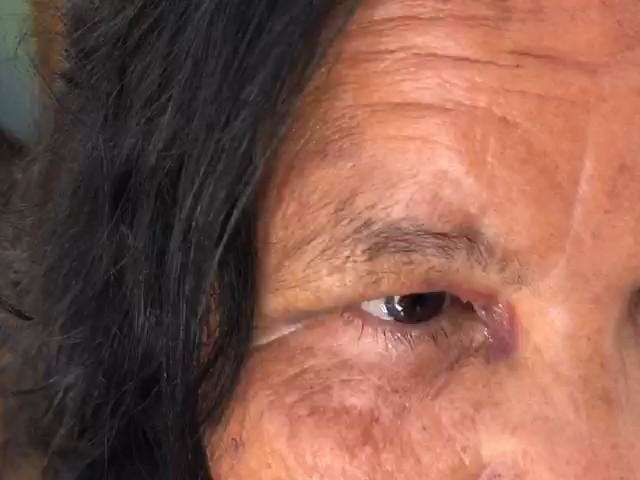 Marcas pelo corpo ainda lembram susto de ataque de pitbull contra idosa