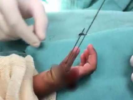 Em cirurgia inédita em MS, dedo indicador vira polegar na mão de criança