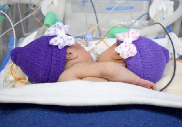 Com 3,8 quilos, irm&atilde;s siamesas est&atilde;o na UTI Neonatal da Santa Casa