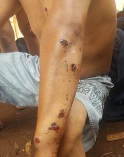 Índio mostra ferimentos durante confronto com seguranças (Foto: Direto das Ruas)