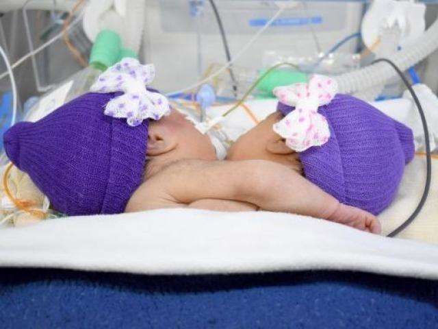 Ap&oacute;s duas semanas de vida, g&ecirc;meas siamesas morrem na Santa Casa