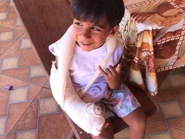 Aos 4 anos, Victor est&aacute; reaprendendo a brincar ap&oacute;s &quot;ganhar&quot; polegar